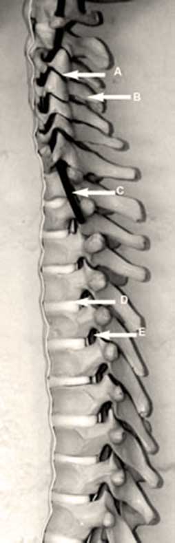 Full spinal column anatomical diagram displaying labeled vertebrae