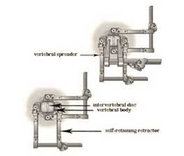 Anterior cervical discectomy diagram