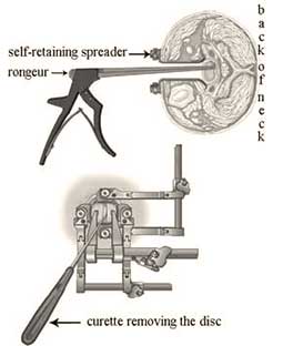 Anterior cervical discectomy disc removal tools