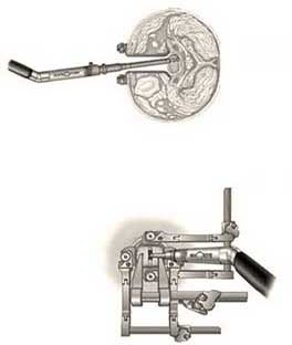Anterior cervical discectomy retractor instrumentation