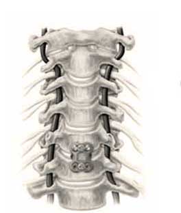 Anterior cervical discectomy and fusion plate