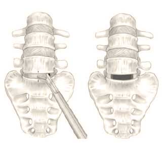 Anterior lumbar discectomy before and after