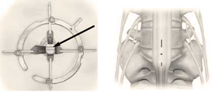Surgical retractor exposure in lumbar arthroplasty