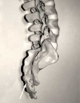 Caudal epidural steroid injection target model