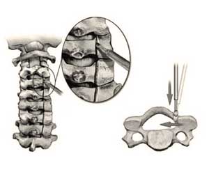 Cervical laminoplasty hinge creation surgical procedure