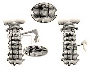 Cervical laminectomy bone removal surgical procedure