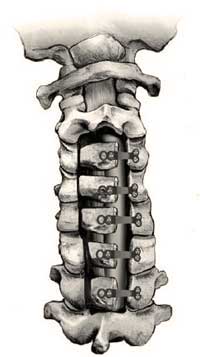 Cervical laminoplasty mini plate fixation