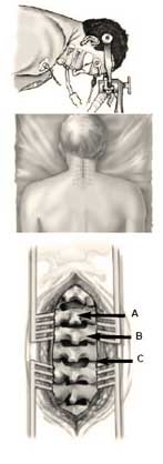 Cervical spine surgery setup and posterior exposure