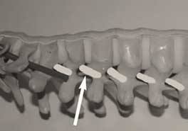 Cervical spine anatomical model showing foraminotomy bone removal