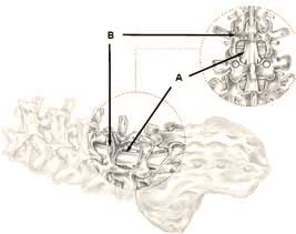 Lumbar laminectomy spinal decompression diagram