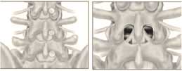 Lumbar laminectomy and decompression anatomy comparison