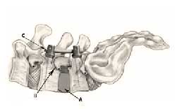Lateral lumbar spinal fusion hardware diagram