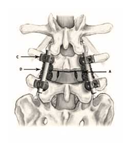Posterior lumbar spinal fusion instrumentation diagram