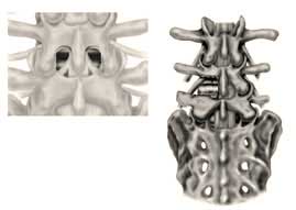 Posterior lumbar spine fusion anatomy comparison