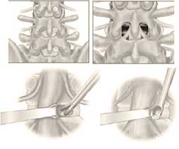Lumbar microdiscectomy surgical steps diagram