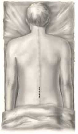 Prone surgical positioning for lumbar spine surgery