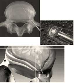 Percutaneous lumbar nucleoplasty coblation procedure