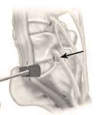 Lumbar discectomy and nerve decompression