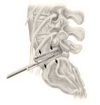 Lumbar disc space distraction tool