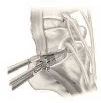 Lumbar disc replacement surgical insertion