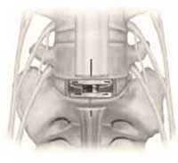 Anterior view of lumbar total disc replacement implant