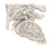Lateral view of lumbar total disc replacement prosthesis