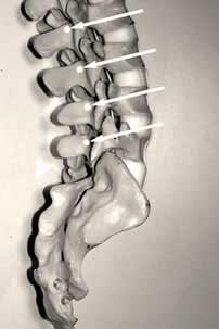 Lumbar radiofrequency rhizotomy target points