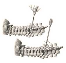 Posterior cervical spine screw placement
