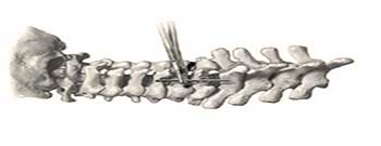 Posterior cervical spine decompression procedure