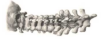 Posterior cervical spine fusion hardware